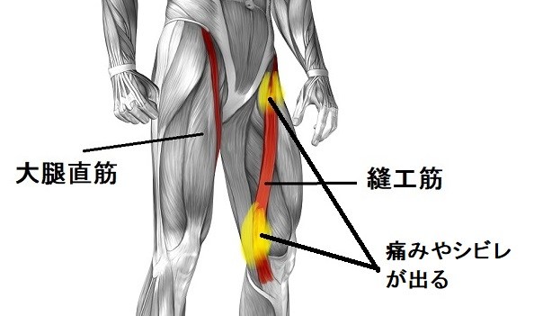 ギックリ腰 脚のシビレ