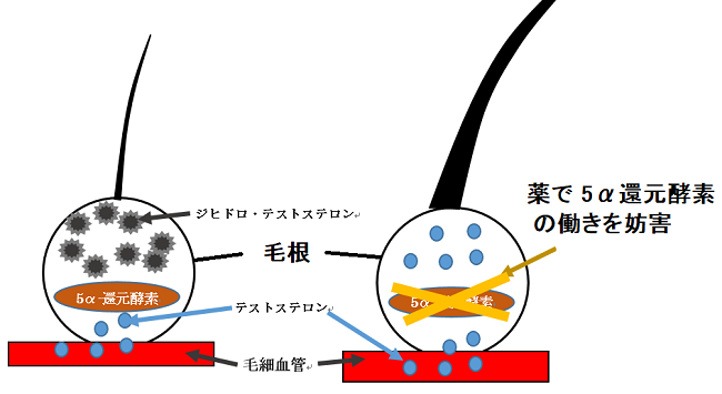 男性型脱毛症AGA 治療 ブログ