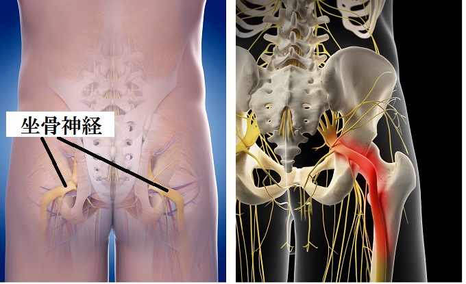 ランナー必見 お尻の痛み 坐骨神経痛 解消法