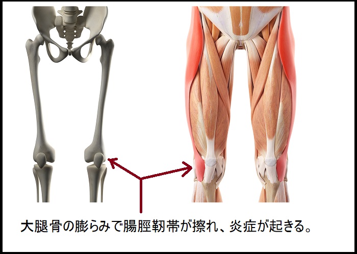 腸脛靭帯炎 ランナー 治療法