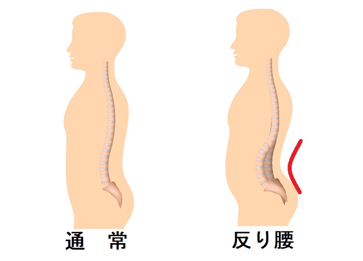 反り腰　でっちり　ストレッチ