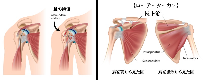 肩 痛い 筋 トレ