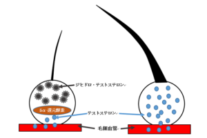 男性型脱毛症AGA 治療 ブログ