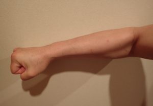 肘内側 痛み 腕橈骨筋・上腕筋 ブログ