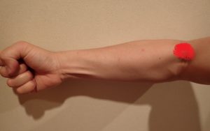 肘内側 痛み 腕橈骨筋・上腕筋 ブログ