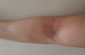 湿布の効果 皮膚のタダレ、カブレ