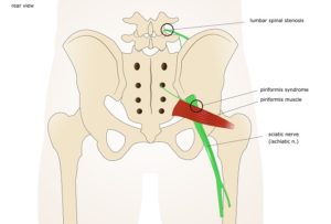 ランナー必見 お尻の痛み 坐骨神経痛 解消法