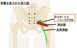 ランナー必見！　坐骨神経痛 マッサージ