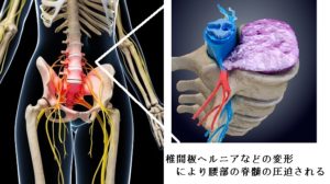 ランナー必見 お尻の痛み 坐骨神経痛 解消法