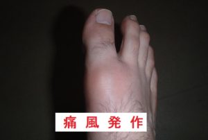 筋トレ　プロテイン　痛風