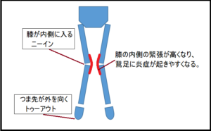 鵞足炎 がそくえん 予防 ランニング