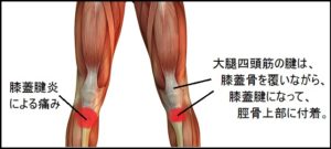 膝蓋靭帯炎 ランニング 膝の痛み