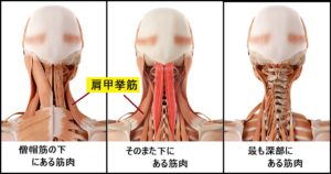 ランナー 肩こり 首こり　治療法