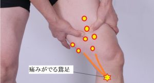 鵞足炎　治療法　対処法　膝内側の痛み