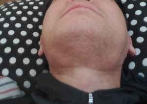 疲れ 首 リンパ腺 脹れ